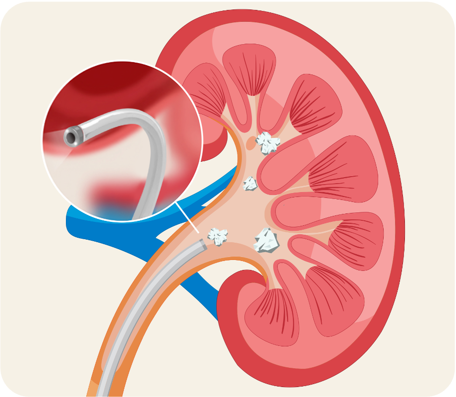 CVAC catheter accessing the kidney through the ureter