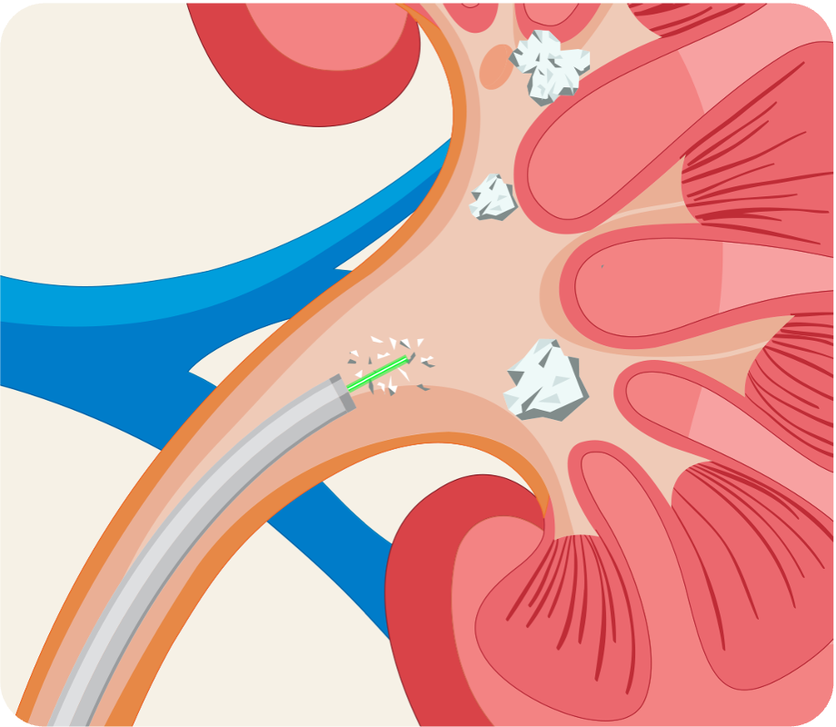 Laser fragmenting kidney stone through CVAC system