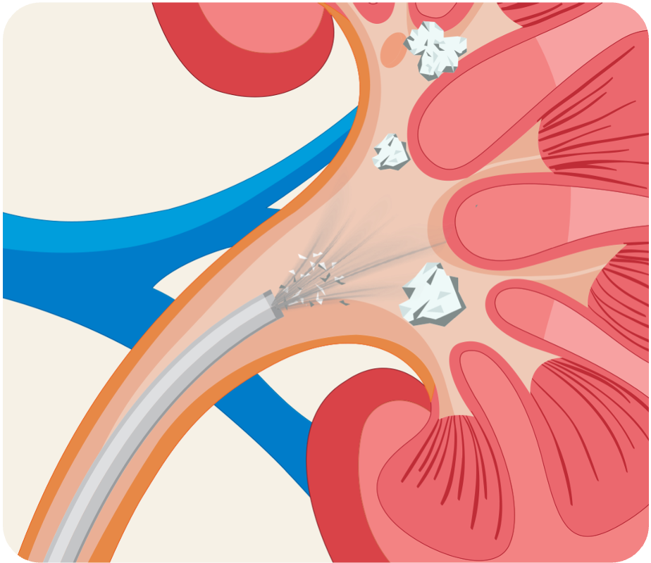 CVAC system vacuuming stone fragments from the kidney