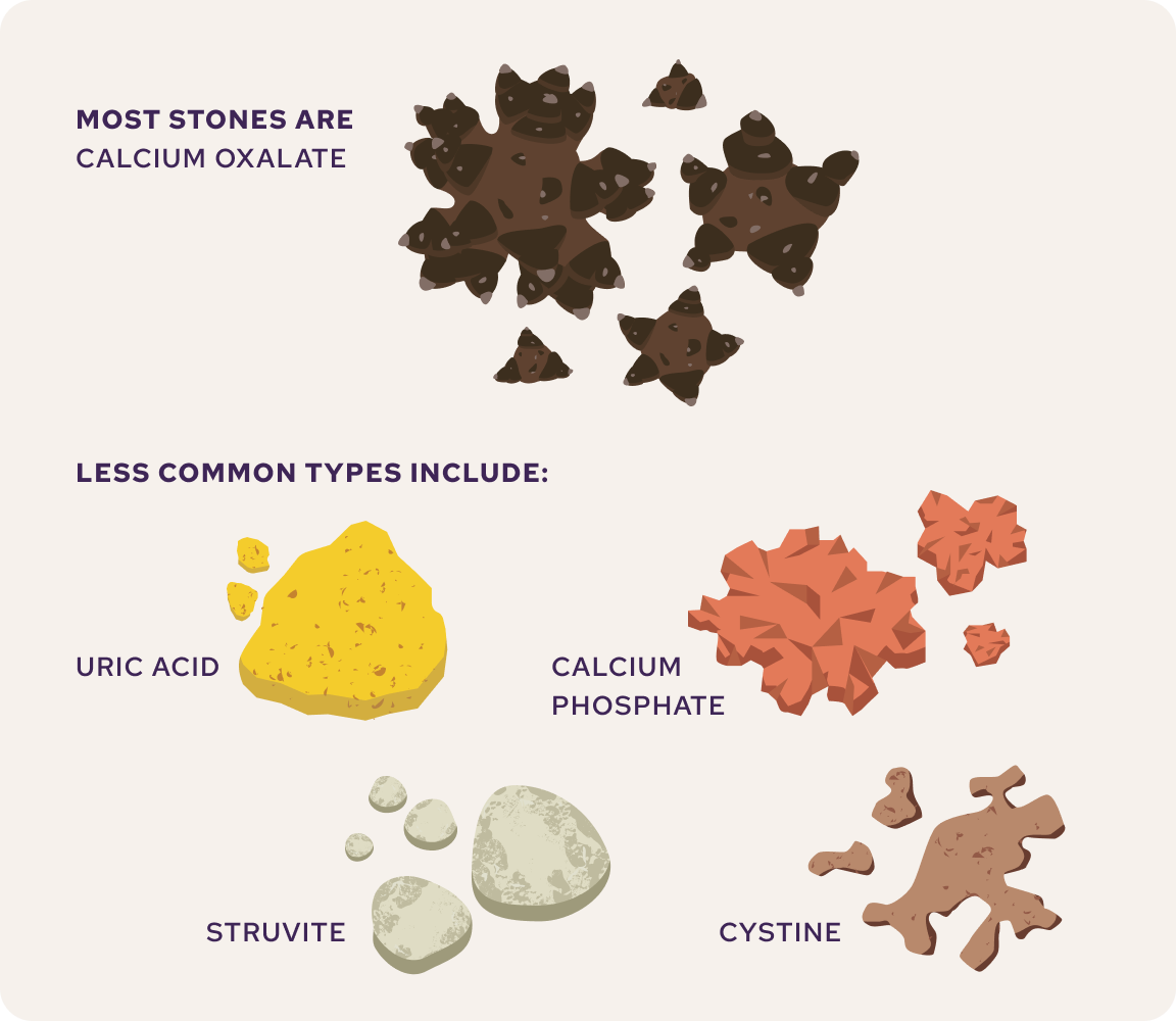 Illustration of kidney stone types: calcium oxalate, uric acid, calcium phosphate, struvite, and cystine stones
